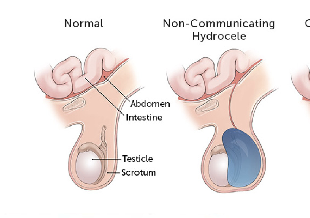 Hydrocele Surgery hospital In Pune