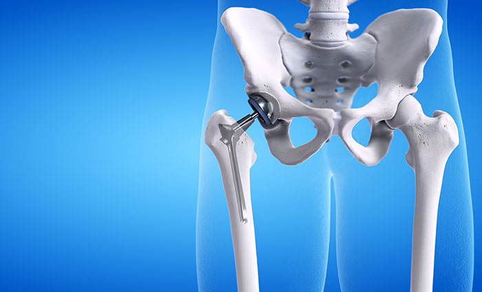 Hip Replacement Surgeon in Pune
