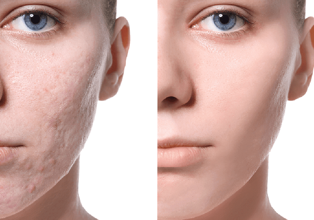 Acne Scar Treatment in pune