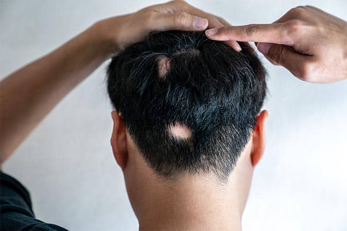 Alopecia/Baldness Treatment In Pune
