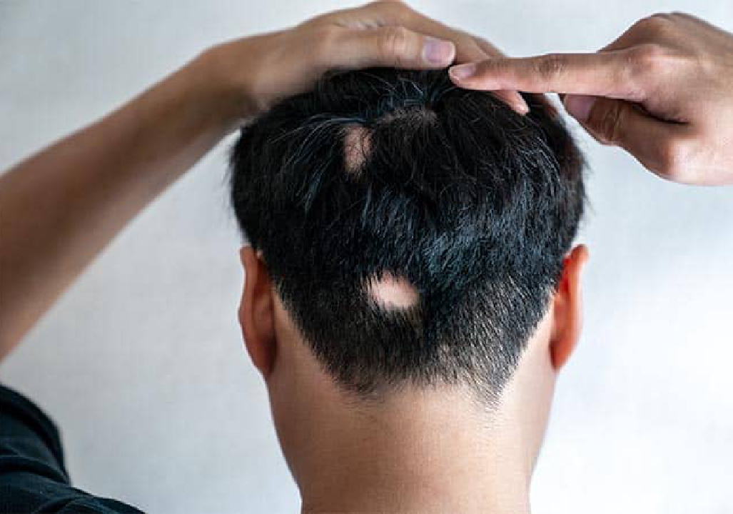 Alopecia/Baldness Treatment  in Pune 