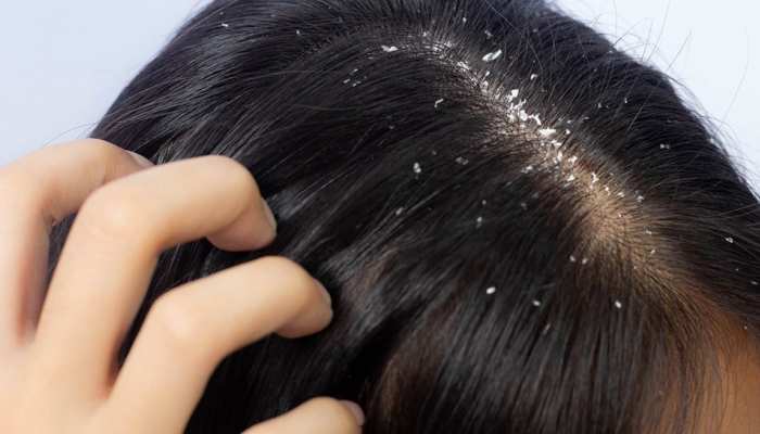 Anti-Dandruff Treatment In Pune 