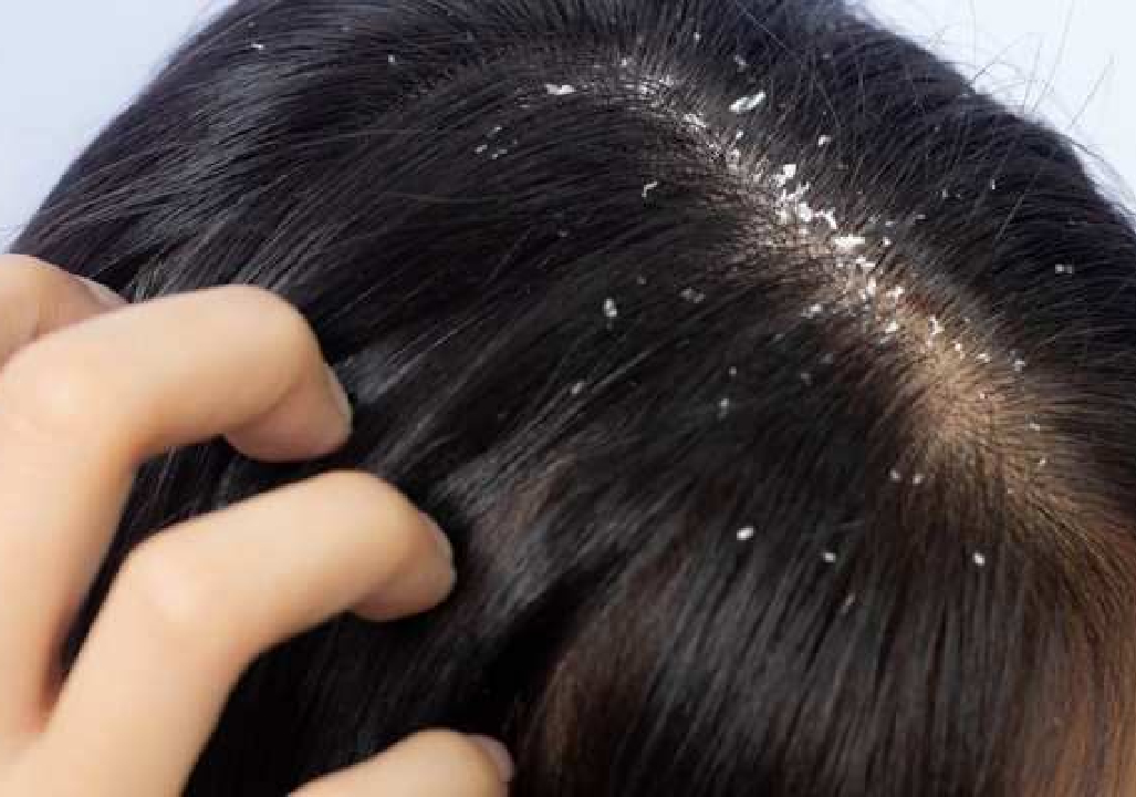 Anti-Dandruff Treatment in Pune