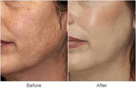 Acne Scar Treatment In Pune