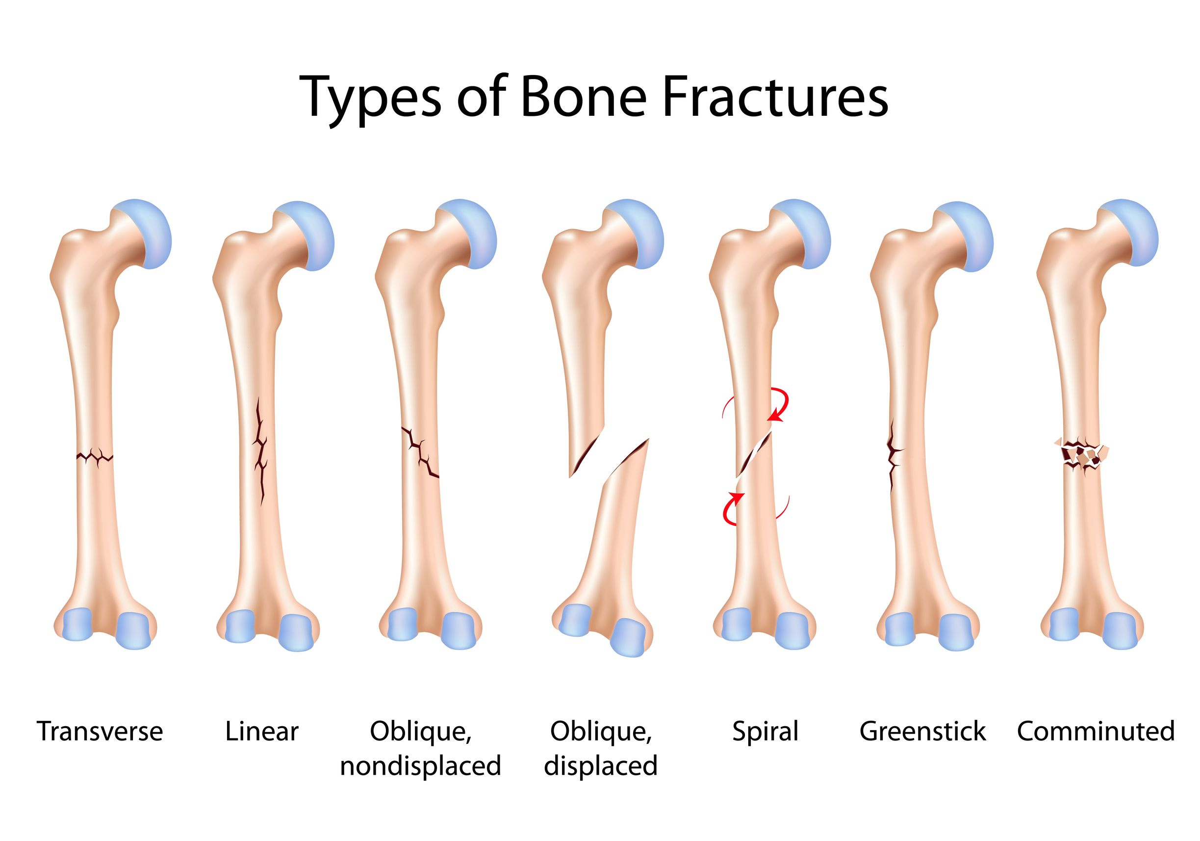Bone Frature Treatment In Pune