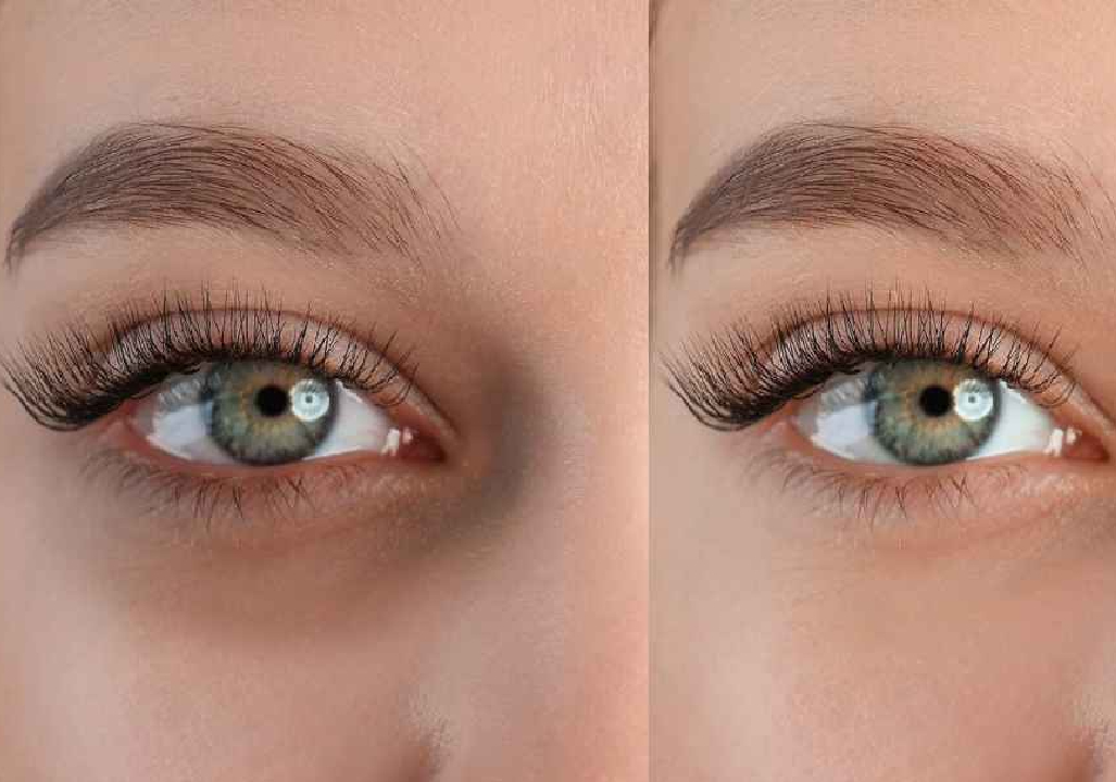 Dark Circle Treatment in pune