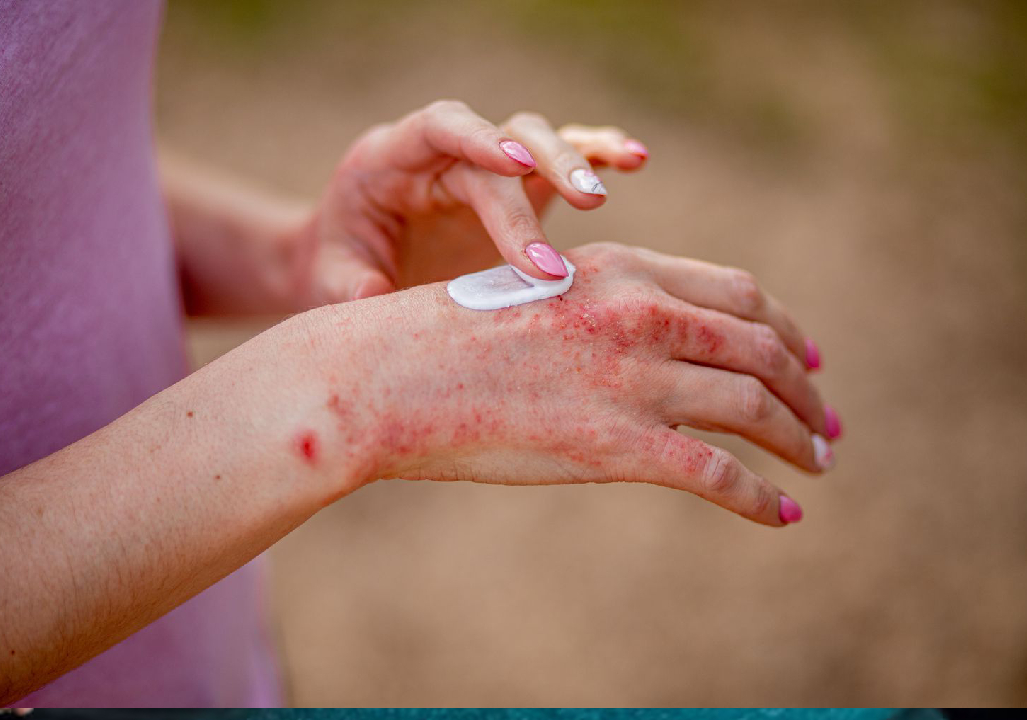 Eczema Treatment in Pune 