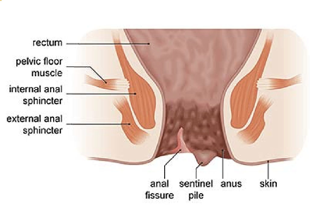 Anal Fissure In pune