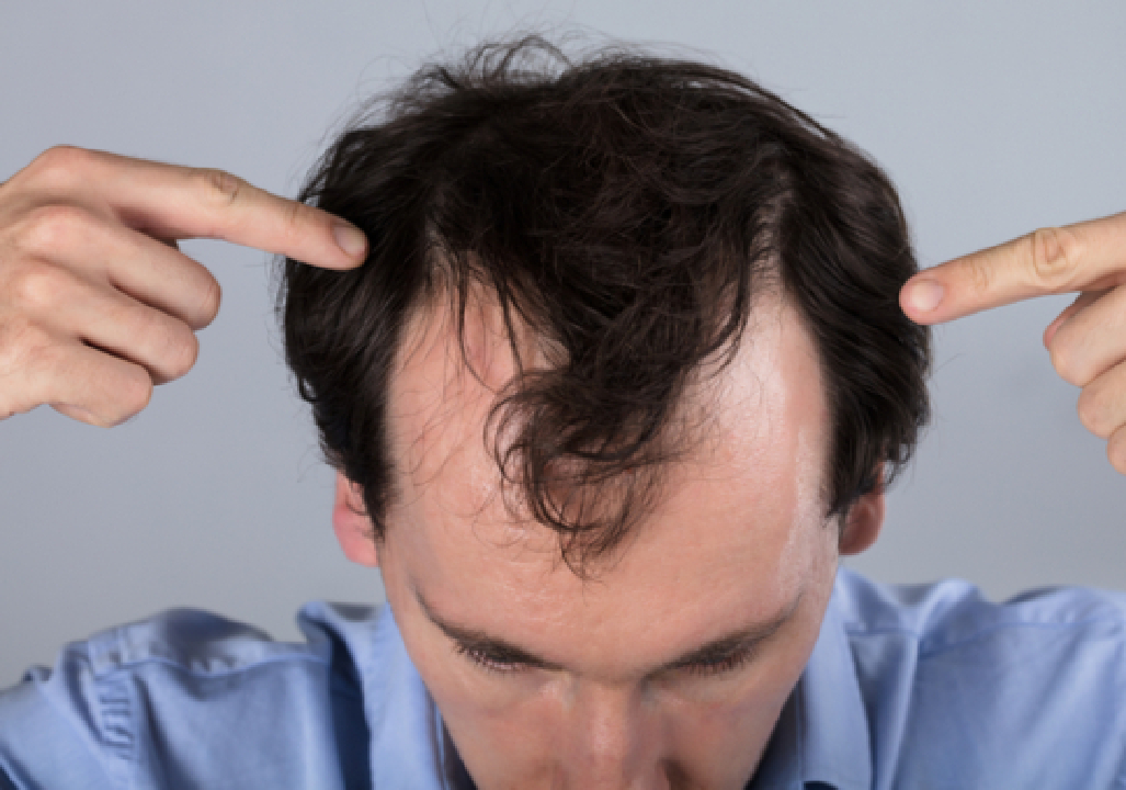 Hair Loss Treatment in Pune 