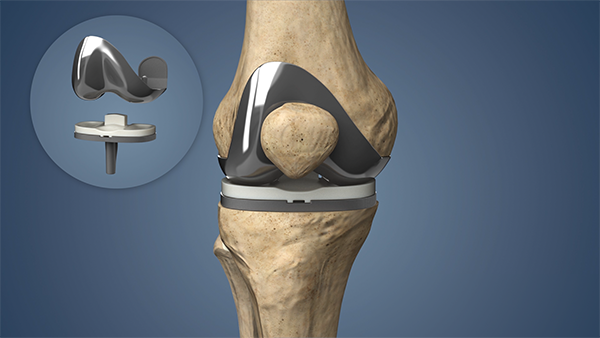 Knee Replacement Surgeon In Pune