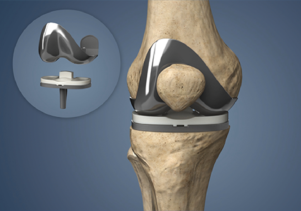 Knee Replacement In Pune