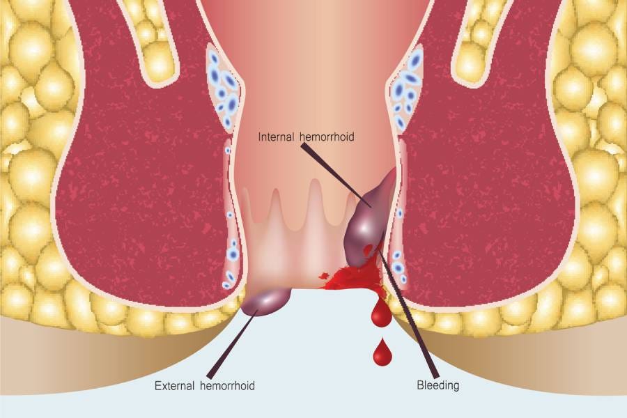 Piles (Haemorrhoids) Specialist in Pune