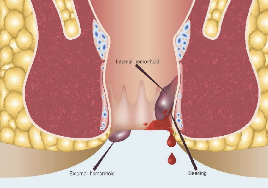Piles specialist In Pune