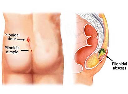 Pilonidal Sinus Treatment in Pune