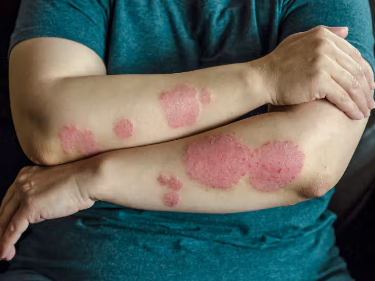 Psoriasis Treatment in pune