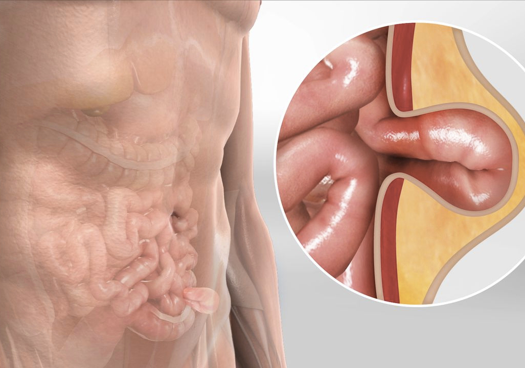 Rectal Prolapse treatment in Pune