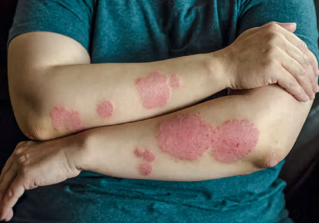 Psoriasis Treatment in pune