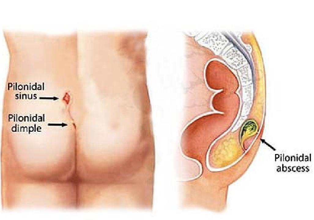 Pilonidal Sinus Treatment In Pune