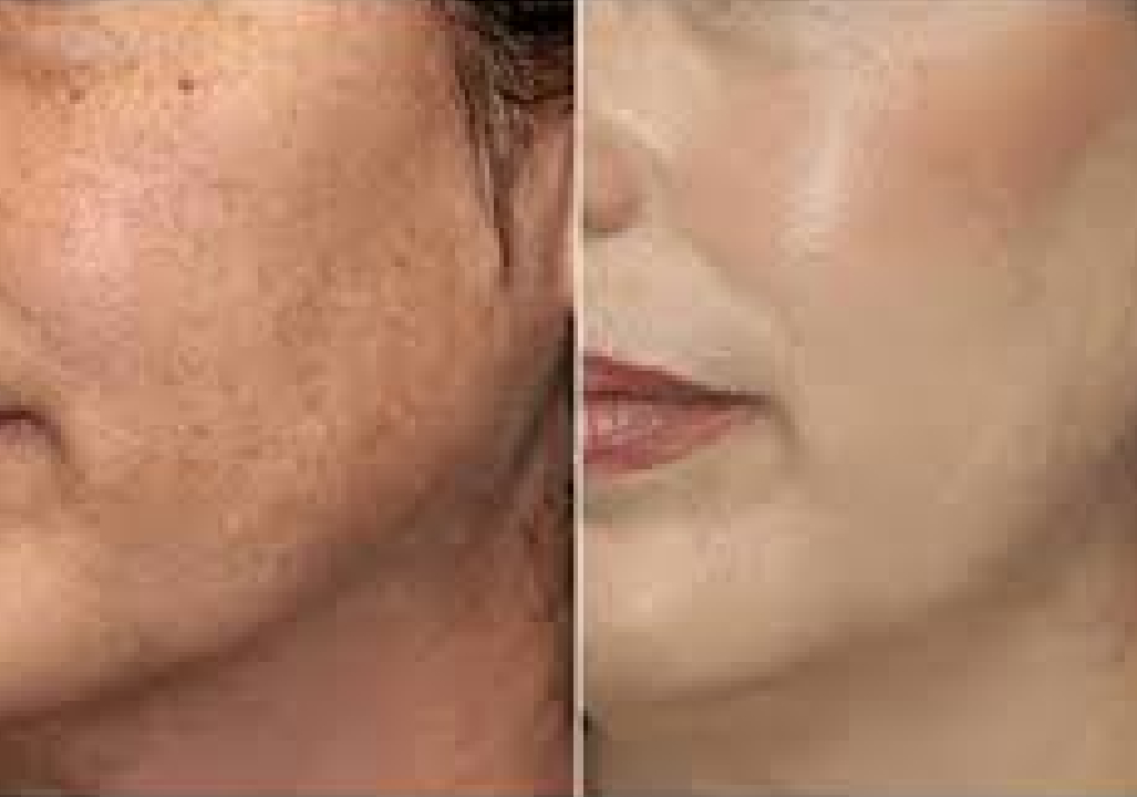 Skin Rejuvenation Treatment in pune